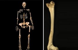 झारखंड, ऑस्टियोजेनेसिस इम्परफेक्टा, अजब गजब ख़बर, Jharkhand, odd news, weird news, osteogenesis