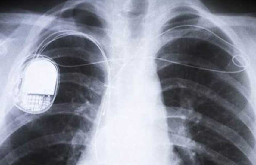 pacemaker, health technology, battery-less pacemaker, health advancement, पेसमेकर, हेल्थ, लाइफस्टाइल, हेल्थ न्यूज़ pacemaker, health technology, battery-less pacemaker, health advancement, पेसमेकर, हेल्थ, लाइफस्टाइल, हेल्थ न्यूज़