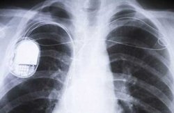 जब दिल से ही चार्ज हो जाएगा पेसमेकर