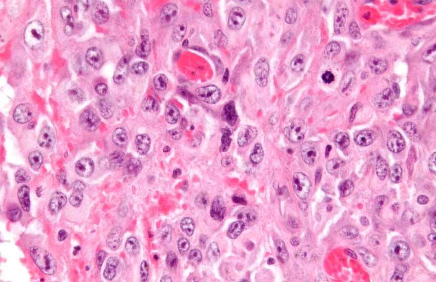 AIIMS Doctors, Limb Salvage Surgery, Sarcoma Patients, health news, medical news