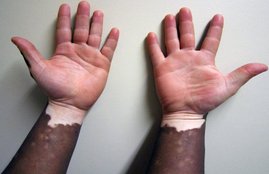 lyukoderma, white spot, treatment, health news
