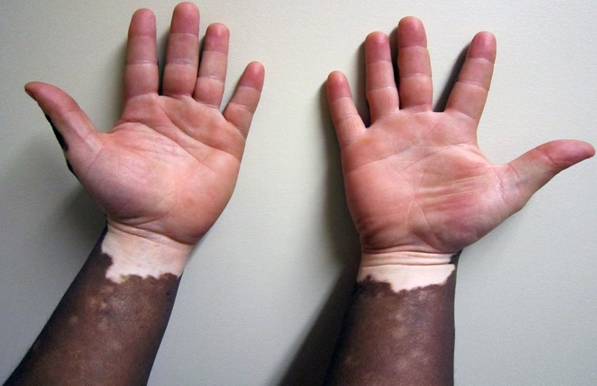 lyukoderma, white spot, treatment, health news