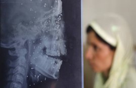 kashmir,pellet guns, kashmir unrest