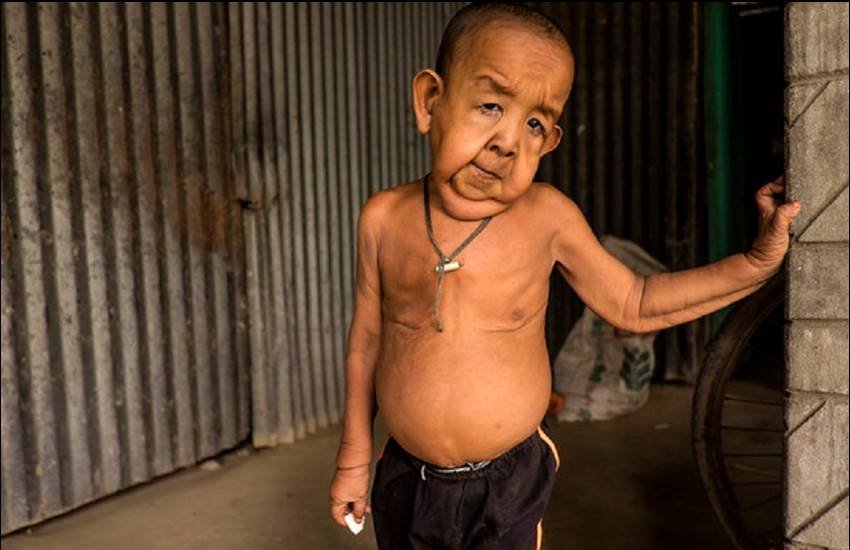 4 Years Old Boy, 4 Years Old looks 80 years, Progeria, progeria disease, progeria disorder, real life paa, Bayezid Hossain, Bayezid Hossain from Bangladesh
