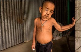 4 Years Old Boy, 4 Years Old looks 80 years, Progeria, progeria disease, progeria disorder, real life paa, Bayezid Hossain, Bayezid Hossain from Bangladesh