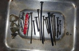 Pakistan, Peshawar, India, Punjab, Operation, Metal objects In Stomach, khives in Stomach