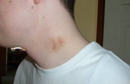 love bite, hickey, Teen dies after love bite, Mexico, Julio Macias Gonzalez, girlfriend
