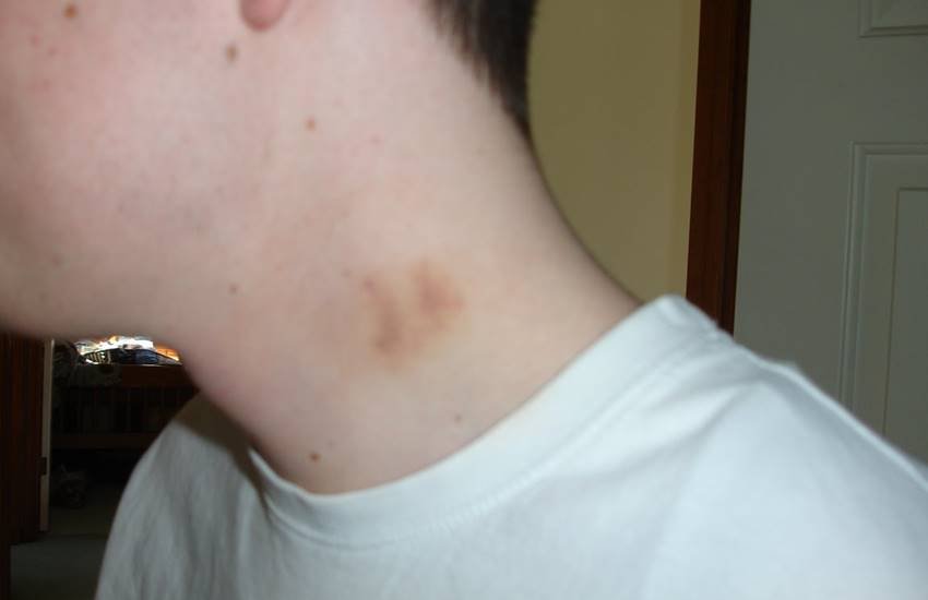 love bite, hickey, Teen dies after love bite, Mexico, Julio Macias Gonzalez, girlfriend