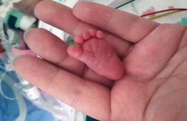Baby Emilia, World's smallest baby, premature birth