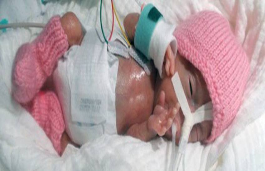 Baby Emilia, World's smallest baby, premature birth