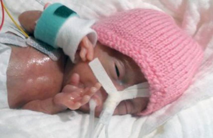 Baby Emilia, World's smallest baby, premature birth