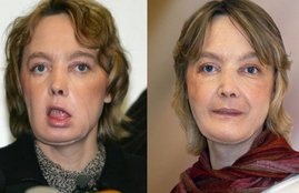 face transplant, Isabelle Dinoire, french