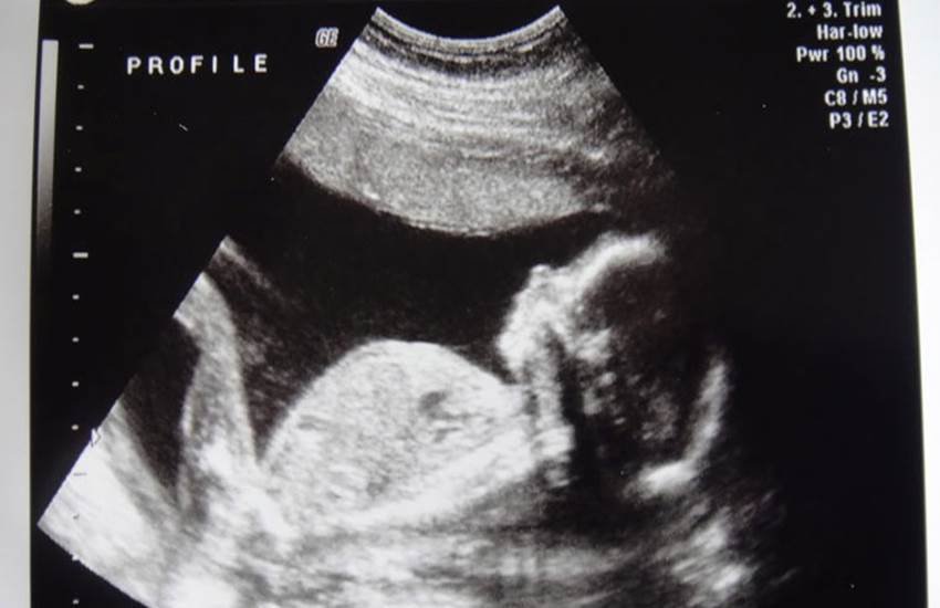 supreme court, sex determination, sex determination keywords, sex determination ad block, sex determination laws, sex determination in india, pre-natal sex determination in india, pre-natal sex determination laws, india news