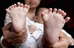 चीन : 10 महीने के इस बच्चे को है 15 उंगलियां और 16 अंगूठे, करानी पड़ेगी तीन बार सर्जरी