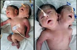 राजस्थान में हुआ दो सिर वाले बच्चे का जन्म, 32 घंटे बाद ही हो गई मौत