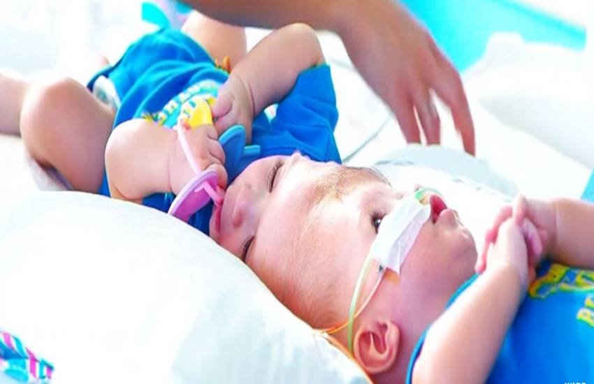 conjoined, Twins, health news, medical news, medical articles, US, Chicago, New York, Twins Joined, Head Separated, After 20 Hours Long Surgery