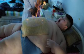 Li Hang, China, Prader-Willi Syndrome, genetic disorder, Chinese medicine treatment to lose weight, how to lose weight, weight loss, weight loss