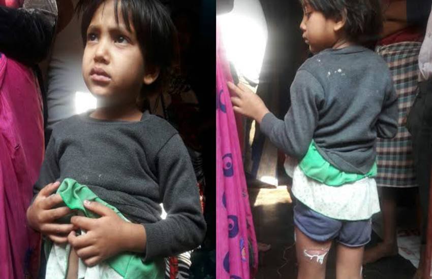  राखी की मां को गुस्सा आ गया और उसने लोहे के चिमटे को चूल्हे में गर्म करके उसके शरीर पर कई जगह दाग दिया।