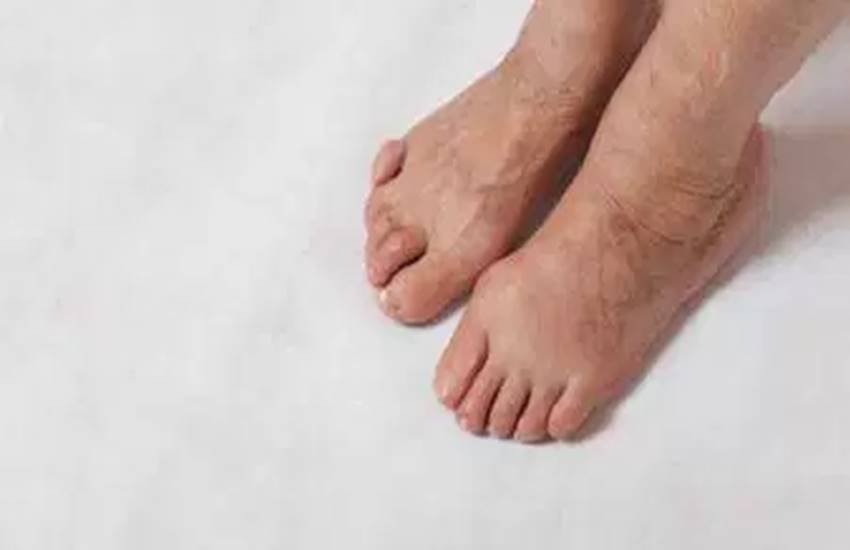 swelling in feet, swelling in feet causes, swelling in feet treatment, home remedies of swelling in feet, swelling in feet in winters, home remedies, health news, health news in hindi