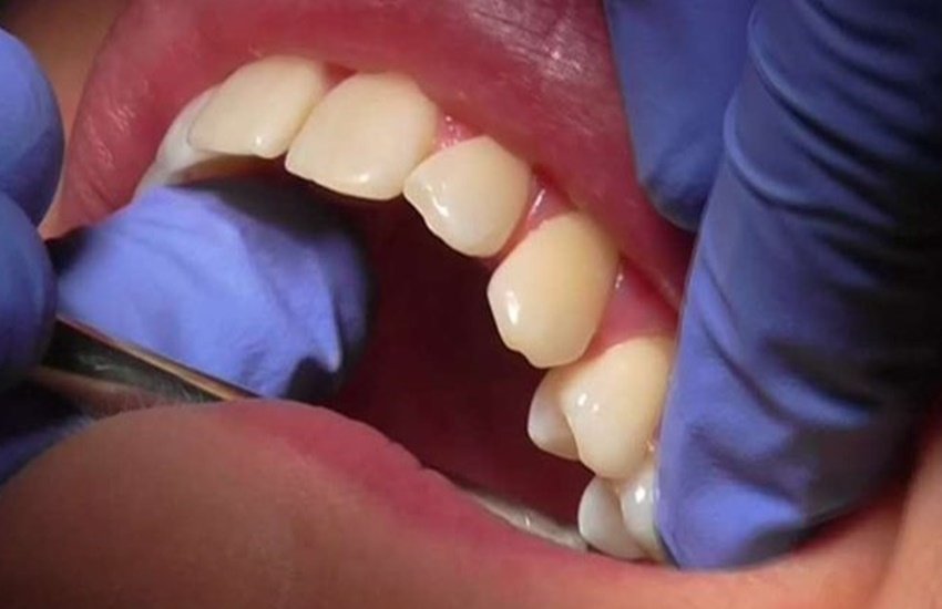 jansatta ravivariya Column, Health Latest news, insect in teeth