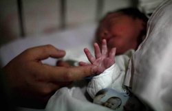 इराक से आए 8 अंग वाले बच्चे को भारत में मिली नई जिंदगी, दुनिया में केवल 5-6 बच्चों के निकलते हैं हाथ-पैर के अलावा 4 अंग