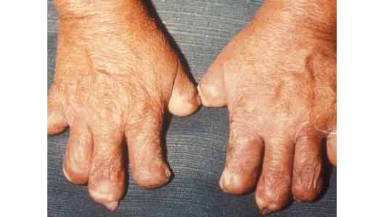 20 साल की कड़ी साधना के बाद आशीष गौतम ने जहां कुष्ठ रोगियों में आत्मविश्वास जगाया है, वहीं उनके बच्चों में दुनिया में कुछ कर-गुजरने का जज्बा भी पैदा किया है।