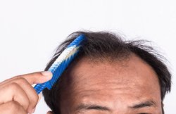 जानिए कई तरह के हेयरफॉल के लक्षण ताकि समय रहते आप कर सकें इलाज