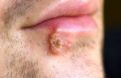 बारिश के मौसम में हो जाएं फुंसी तो अपनाएं ये घरेलू उपाय