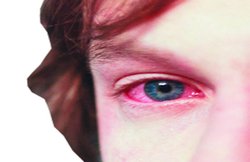 सेहत- नेत्रशोथ यानी कंजंक्टिवाइटिस