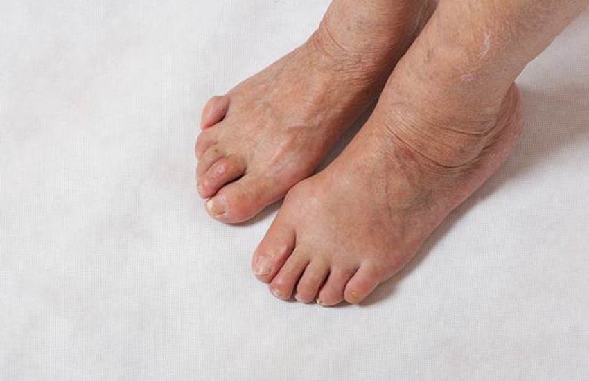 Swollen Feet, Feet Problems, Home remedies, How To Treat Swollen feet, Feet Health Tips, Pregnancy, Edema, Heart Diseases, Cancer, Health News In Hindi, Lifestyle News In Hindi, Jansatta