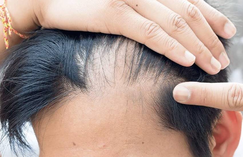 Hair Loss, Regain Hair, How To Regain Hair, Natural Remedies, Home Remedies, Hair Problems, Hair Health Tips, Protein, Beauty Tips In Hindi, Lifestyle News In Hindi, Health News In Hindi, Jansatta Hair Loss, Regain Hair, How To Regain Hair, Natural Remedies, Home Remedies, Hair Problems, Hair Health Tips, Protein, Beauty Tips In Hindi, Lifestyle News In Hindi, Health News In Hindi, Jansatta