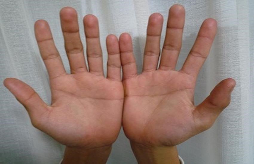 Hand Lines, Hand Lines and pain, Hand Lines and bone, Planets, Planets and pain, Planets and bone pain, Bone Pain, Bone Pain reason, Bone Pain and astrology, astrology and pain, astrology and bone pain, astrology News