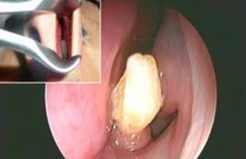 teeth in nose