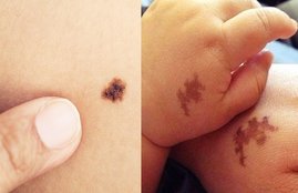 birthmark, birth mark, what is mark, what is mark on body, why mark on body, mark on body means, birthmark on body part means, birth mark on chest means, mark on body part, mark on body parts means, birthmark existence means, birthmark on face means, vastu news, birthmark reflects personality, astro news in hindi, birthmark explanation in hindi, religious news, latest vastu and astro news, jansatta