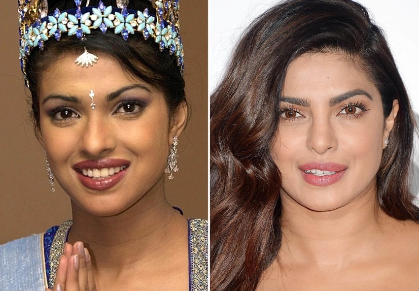 Cosmetic Surgery, Actress Surgery, Surgery Went Wrong, Kangana Ranaut, Minisha Lamba, Anushka Sharma, Sushmita Sen, Gauhar Khan, Shilpa Shetty
