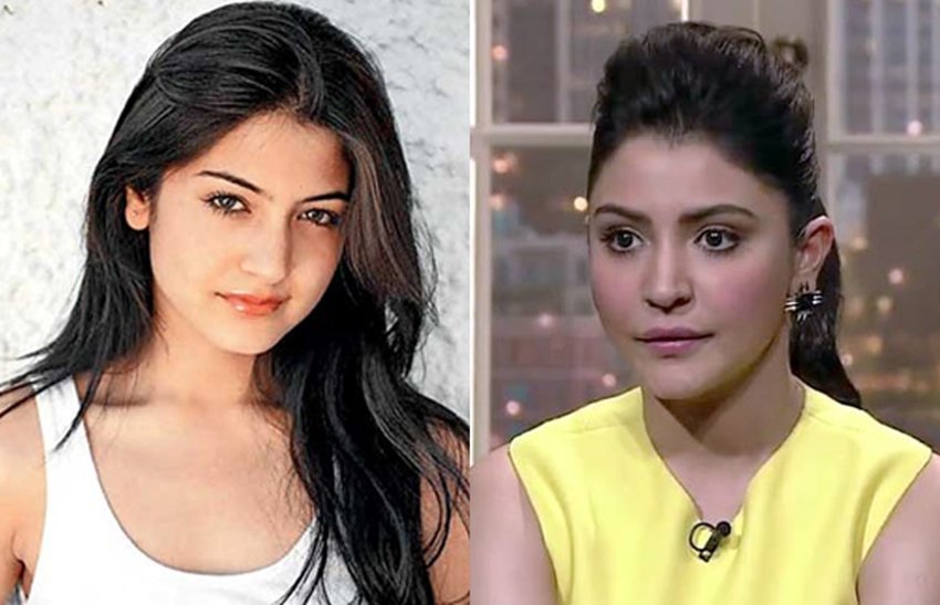 Cosmetic Surgery, Actress Surgery, Surgery Went Wrong, Kangana Ranaut, Minisha Lamba, Anushka Sharma, Sushmita Sen, Gauhar Khan, Shilpa Shetty