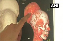 Mumbai, Mumbai news, Tumor, Brain Tumor, Brain surgery, Nair Hospital, Medical news, Health news, Hindi news, jansatta