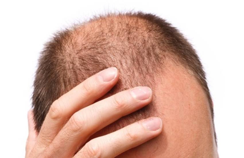 hair transplantation, hair transplantation side effects in hindi, hair transplant side effects long term in hindi, how does hair transplant work in hindi, hair transplant, baldness, how to cure baldness, hai fall problem, lifestyle news in hindi, health news in hindi, jansatta
