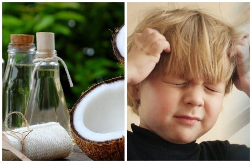 lice, hair lice, how to get rid of hair lice, how to treat head lice, head lice prevention, head lice home remedies in hindi, coconut oil, coconut oil for head lice, health tips in hindi, healthy lifestyle tips in hindi, lifestyle news in hindi, home remedies in hindi, natural remedies, healthy foods, healthy living, healthy life, lifestyle news in hindi, jansatta