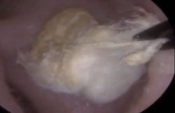 कान में चली गई थी रूई की कली, देखें डॉक्टरों ने 10 साल बाद कैसे निकाली