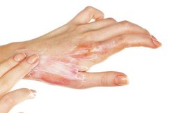 जल जाए शरीर का कोई अंग तो ना करें ये 7 गलतियां, हो सकता है नुकसान