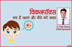 एक्सपर्ट सलाह: बच्चों को Chickenpox से कैसे महफूज रखें, अगर हो जाए तो यूं करें उपचार