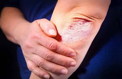 सोरायसिस से हैं परेशान तो आजमा कर देखें ये घरेलू तरीके