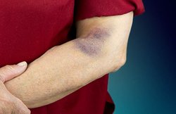 त्वचा पर नील पड़ जाएं तो उसके लिए कौन से उपचार अपनाएं