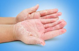psoriasis, winter, remedies for psoriasis, expert advice, lifestyle news, lifestyle, health, skin, skin care, skin care tips, News Headlines, न्यूज़ समाचार, hindi news, news in hindi, jansatta