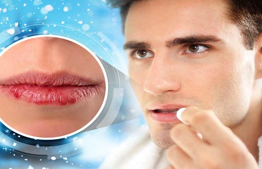 फटे होठ (Source: Indian Express) फटे होठ (Source: Indian Express)