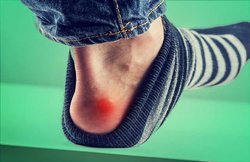 यदि आपके पैरों में भी हमेशा छाले हो जाते हैं, तो ये घरेलू उपचार आपकी समस्या को कर सकते हैं कम