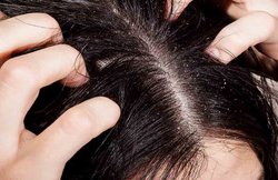 डैंड्रफ की समस्या से छुटकारा दिला सकती है लहसुन, जानिए इस्तेमाल का तरीका