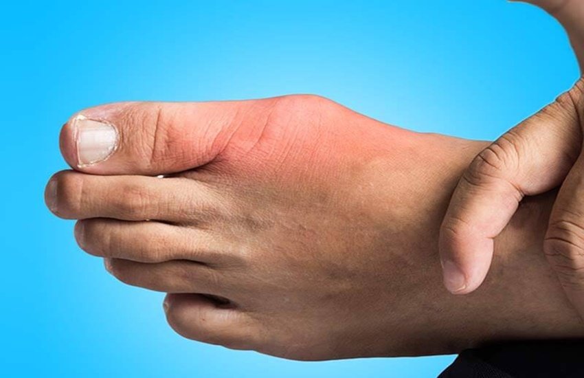यूरिक एसिड बढ़ने पर अपनाएं टिप्स (Source: Dreamstime)