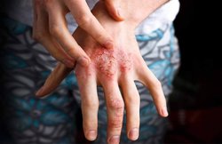 एक्जिमा की समस्या के हैं शिकार तो नीम का करें इस प्रकार इस्तेमाल